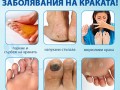 Лек за гъбички